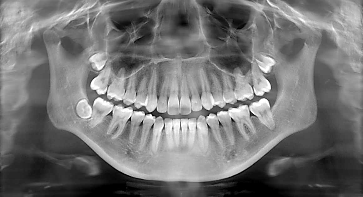 Dental x-ray | Wisdom Teeth